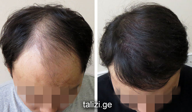 can hair loss regrow